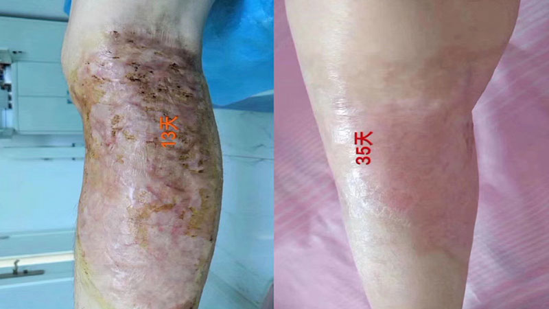 疤痕修复 疤痕修复